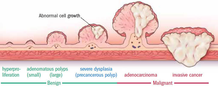 Polyp Types Pictures
