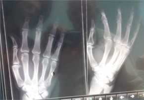 x-ray